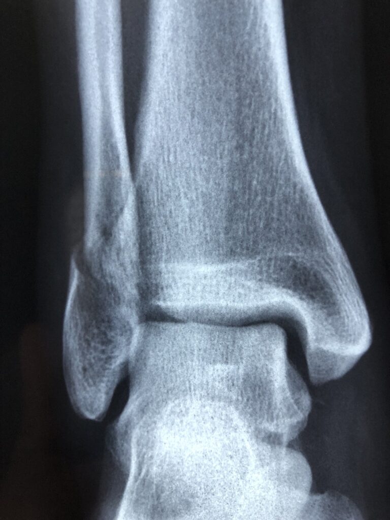 radiography-g0ab082e8a_1280 osso, osteoporosi, articolazione