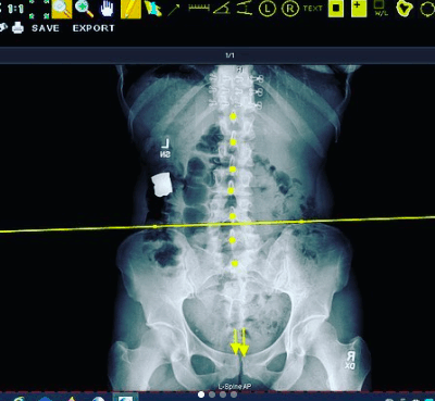 UpperCervical_lastra lastra