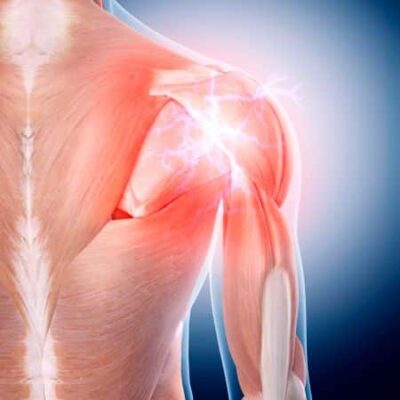 mesoterapia